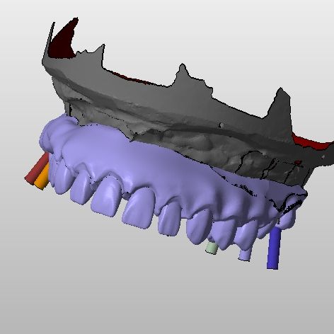 odbudowa wyrostka zębodołowego i zębów na 6 implantach