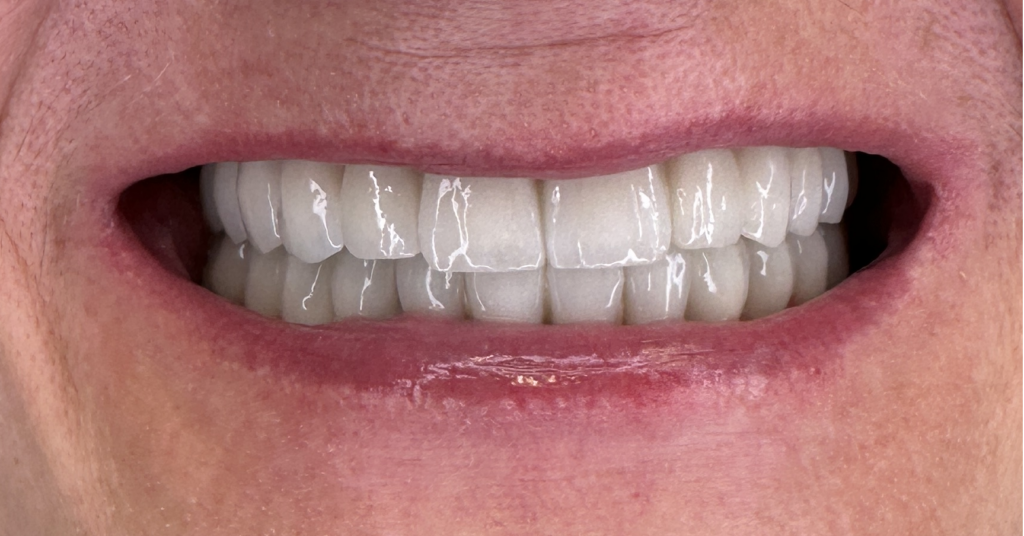 Odbudowa całego uśmiechu na 10 implantach