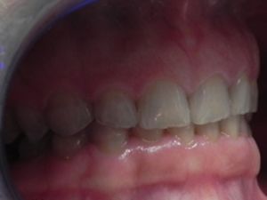 stan początkowy - zęby starte w wyniku bruksizmu