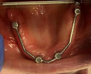 Widok systemu mocowania w ustach Pacjentki widoczny w lusterku