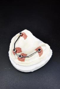 indywidualna belka tytanowa frezowana osadzona na 4 implantach
