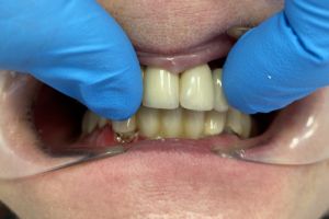 stan początkowy - widok ruchomości zębów