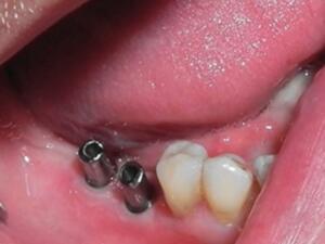 łączniki indywidualne tytanowe tuż po zainstalowaniu w ustach Pacjenta