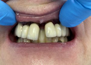 stan wyjściowy, zęby rozchwiane w 3 stopniu, protetyka na zębach całkowicie zdekomponowana