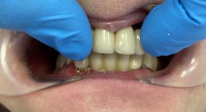 stan początkowy i ruchomość zębów przy rozpoczęciu pracy