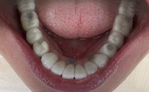 widok zamontowanej pracy łuku dolnego w ustach Pacjentki, most MONOBRIDGE z koronami pełnoceramicznymi 