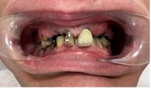stan wyjściowy, znaczne zniszczenie zębów, widoczne korzenie, które stanowiły podstawę odbudowy 