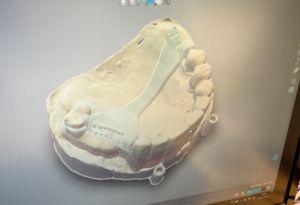 projekt protezy szkieletowej na zasuwach 