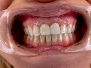 poprawa estetyki uśmiechu - wymiana koron pełnoceramicznych na jedynkach górnych, wybielanie zębów łuku górnego i łuku dolnego